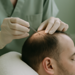 Understanding Hair Implants: A Comprehensive Guide