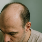 Understanding Male Pattern Baldness and Thinning Hair