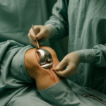 Understanding Total Knee Replacement Surgery: A Comprehensive Guide