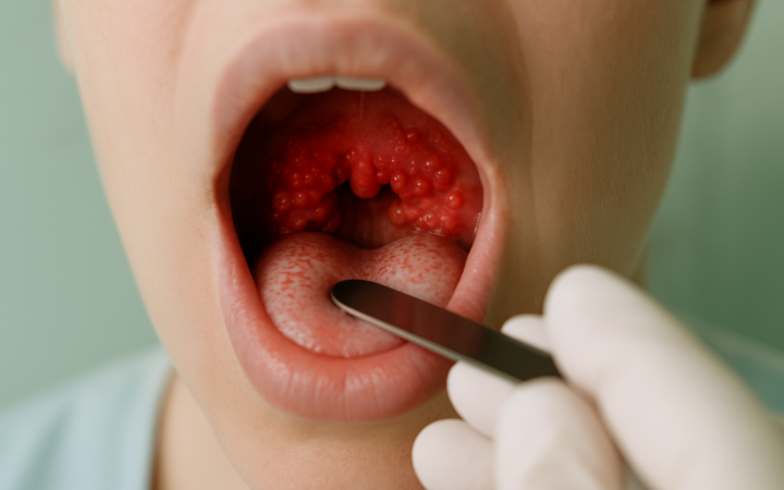 Understanding the Causes of Red Bumps at the Back of the Throat
